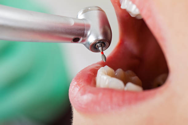 Best Emergency Dental Care for Broken or Chipped Teeth in Danville, VA